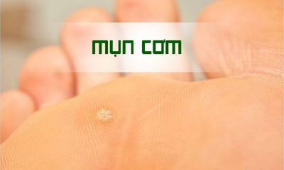 Cách trị mụn cơm ở mặt tại nhà hiệu quả và nhanh chóng